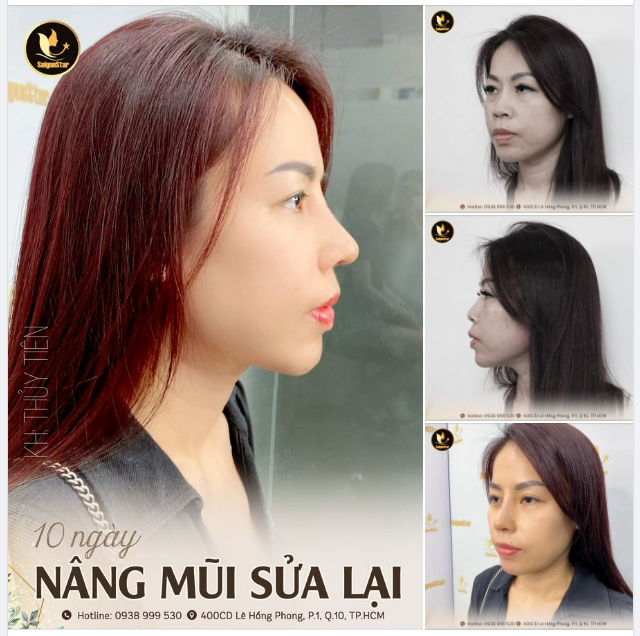 NÂNG MŨI SỬA LẠI – TẠO HÌNH DÁNG MŨI S-LINE