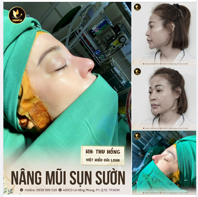 NÂNG MŨI SỤN SƯỜN – ĐẸP BỀN VỚI THỜI GIAN