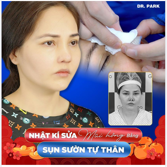 NÂNG MŨI SỤN SƯỜN - PHƯƠNG PHÁP PHỤC HỒI TỐT NHẤT CHO MŨI BIẾN DẠNG