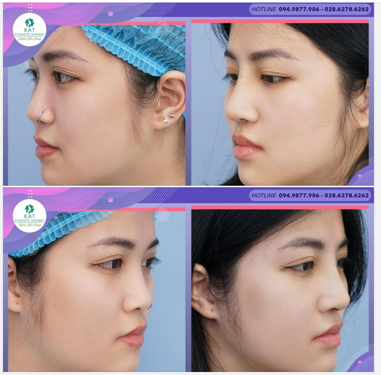 NÂNG MŨI SỤN TAI - Gương mặt ĐẸP không góc chết