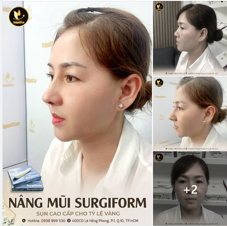 NÂNG MŨI SURGIFORM – SỤN CAO CẤP CHO TỈ LỆ VÀNG