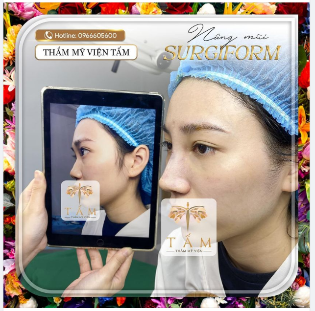 Nâng mũi Surgiform update dáng mũi hoàn toàn khác biệt