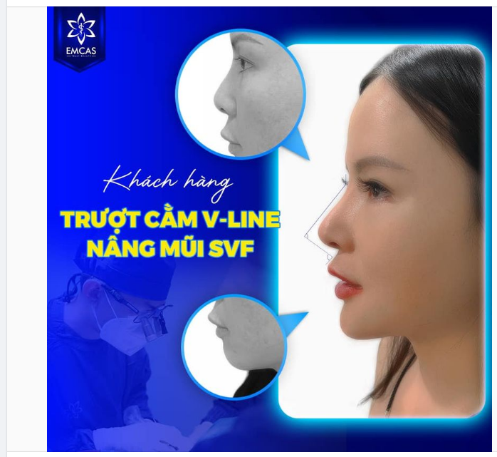 NÂNG MŨI SVF VÀ TRƯỢT CẰM V-LINE Tôn tạo cấu trúc khuôn mặt thon gọn