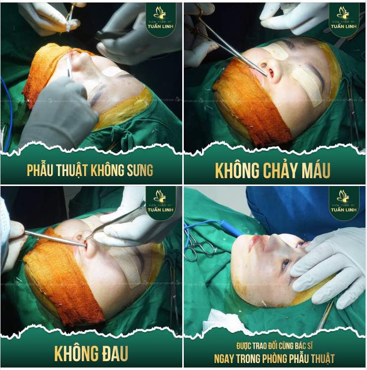 NÂNG MŨI TẠI TUẤN LINH - AN TÂM - AN TOÀN - BỀN ĐẸP.