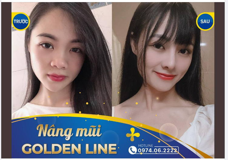 Nâng mũi thay đổi khuôn mặt, thần thái của một người!