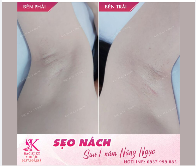NÂNG NGỰC CÓ ĐỂ LẠI SẸO KHÔNG