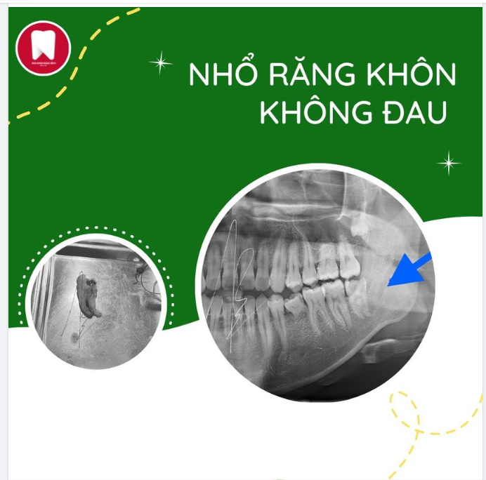 NẾU BẠN SỢ NHỔ RĂNG BỊ ĐAU - HÃY ĐẾN NHA KHOA NGỌC BÍCH