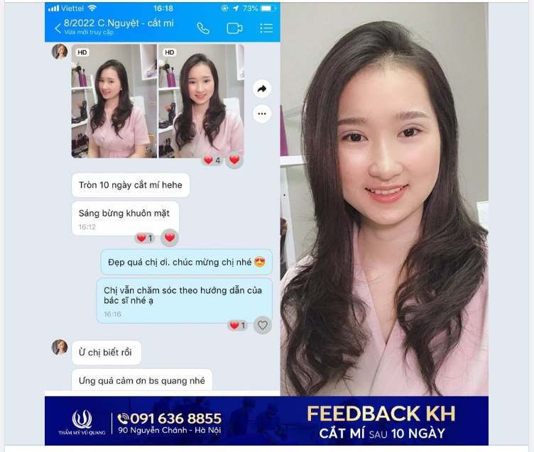 Ngắm nhan sắc 'bừng sáng của bạn Như Nguyệt - 27 tuổi sau 10 ngày Cắt mí Baby West 9D.