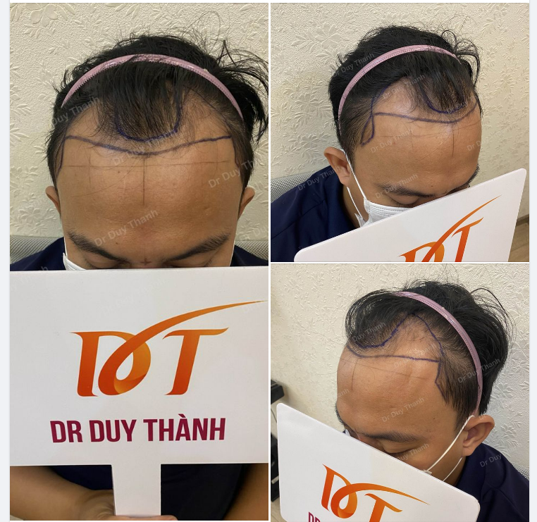 NGÀY MƯA GIÓ, CHUẨN BỊ CẤY 2150 NANG TÓC CHO KHÁCH HÀNG 30 TUỔI