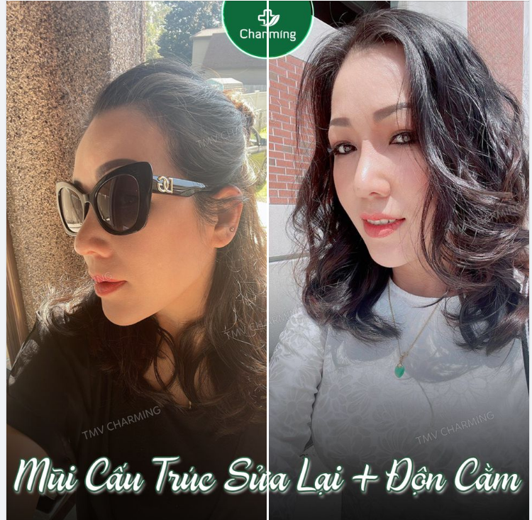 Ngày thấy chiếc mũi trước đó đã nâng bị lỗi, em cứ ngỡ đâu cuộc sống bế tắc.