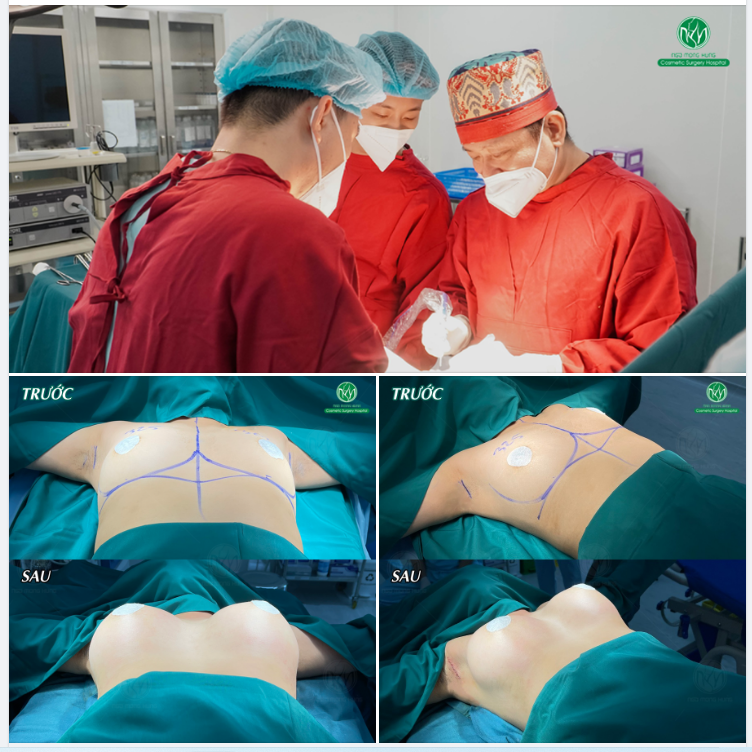 NGỰC NỘI SOI ĐẶT TÚI NANO ERGONOMIX