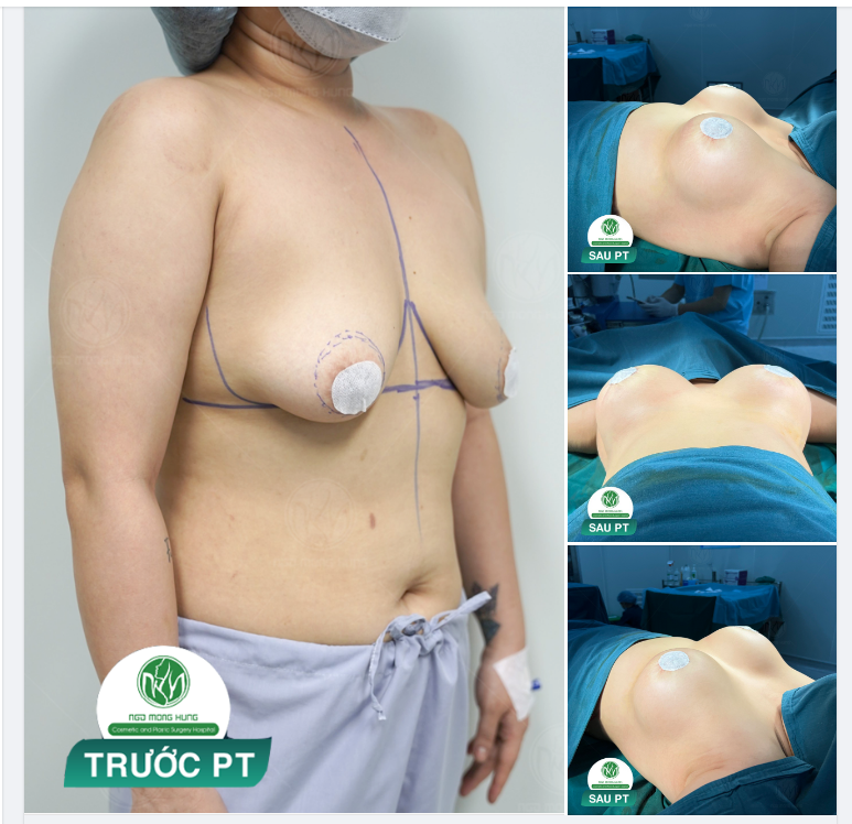 NGỰC TREO ĐẶT TÚI KẾT HỢP THU QUẦNG V.Ú