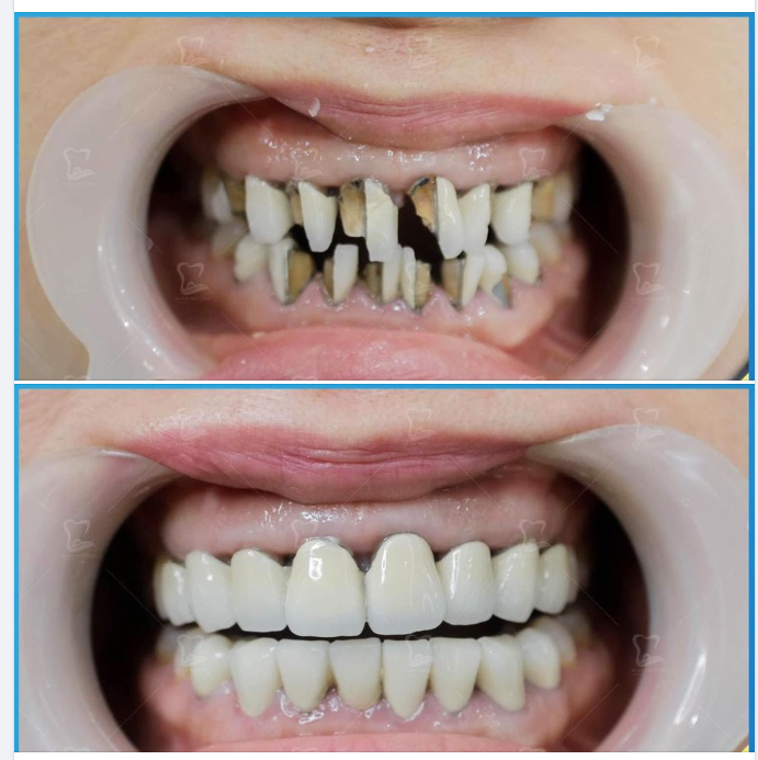 Nha khoa gặp không ít những ca mà khách hàng phải “cấp cứu" nụ cười bởi tác hại của răng sứ giá rẻ.