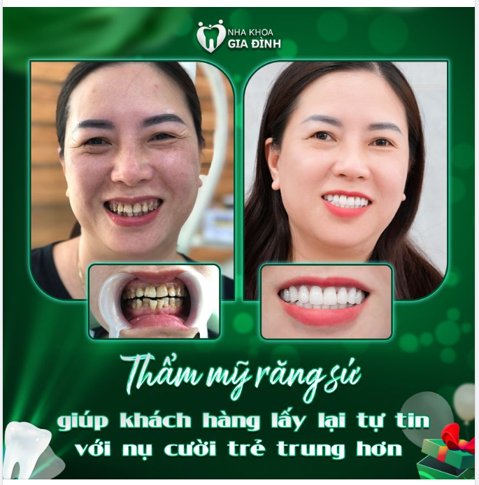 NHAN SẮC BỪNG SÁNG SAU KHI LẤY LẠI NỤ CƯỜI TỰ TIN