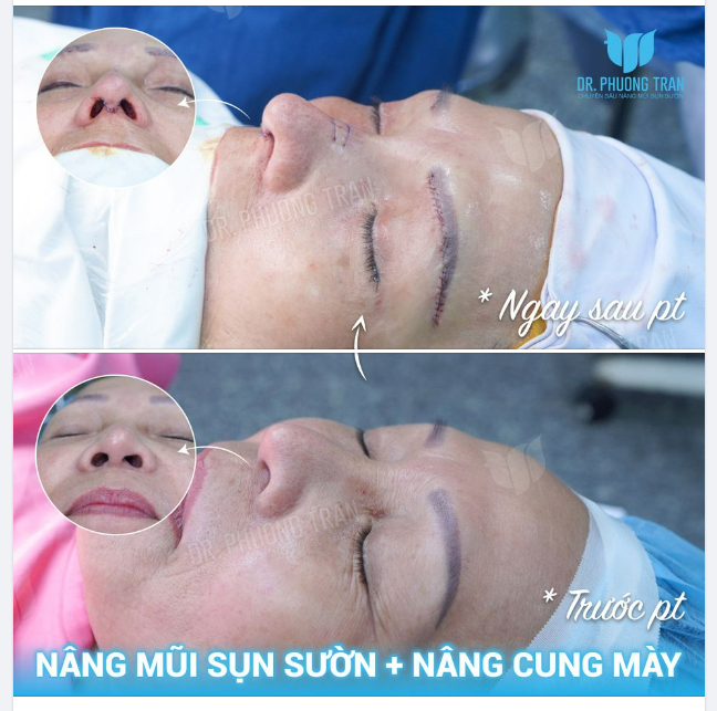 Nhiều người nghĩ Sụn sườn chỉ nên dành cho người trẻ
