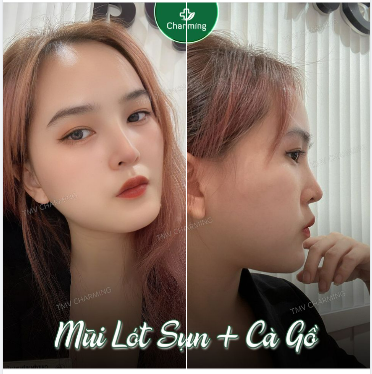 Nhìn em xem…. chiếc mũi lót sụn + cà gồ vừa đầy tháng… có lung linh không Á à, nhìn đấy nhé, nhìn mũi nhé, chứ nhìn chỗ khác là giận ó