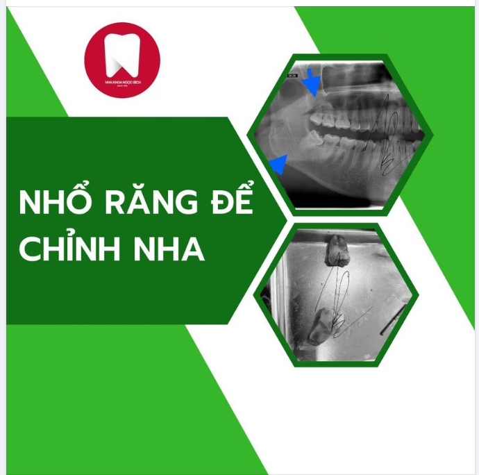 NHỔ RĂNG ĐỂ CHỈNH NHA - CÓ CẦN THIẾT KHÔNG