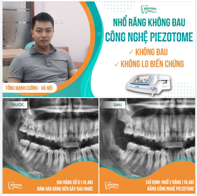 NHỔ RĂNG NHẸ NHÀNG - RỘN RÀNG NIỀM VUI