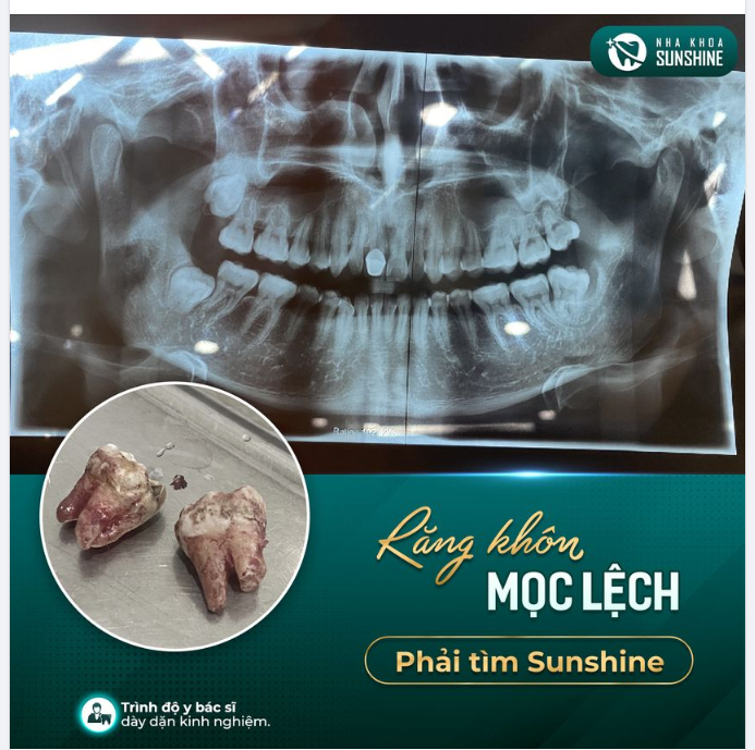 Những chia sẻ của khách hàng sau khi nhổ răng khôn tại Sunshine.