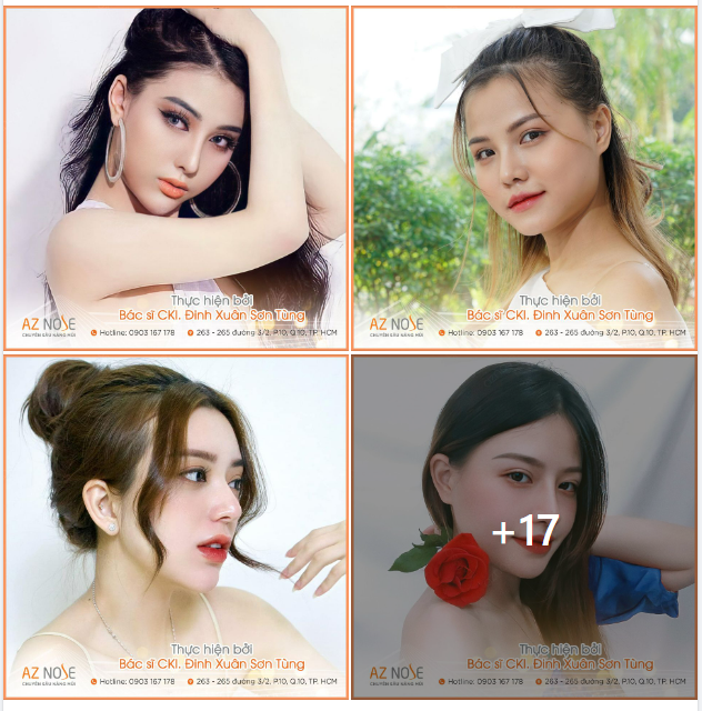 Những dáng mũi được các nàng “săn đón” và thực hiện bởi Bác sĩ Sơn Tùng
