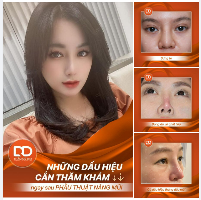 NHỮNG HIỆN TƯỢNG XUẤT HIỆN SAU PHẪU THUẬT NÂNG MŨI.