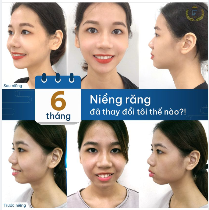 NIỀNG RĂNG, BẠN ĐẸP LÊN TỪNG NGÀY