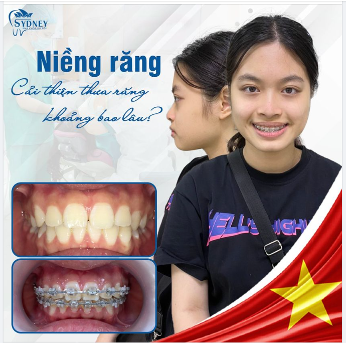 NIỀNG RĂNG CẢI THIỆN RĂNG THƯA KHOẢNG BAO LÂU?