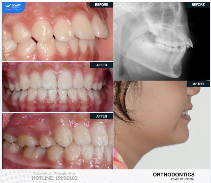  NIỀNG RĂNG CHỈNH HÔ TÌM LẠI SỰ TỰ TIN VỐN CÓ