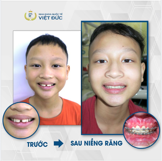 NIỀNG RĂNG CHO CON CÀNG SỚM - HIỆU QUẢ CÀNG CAO!