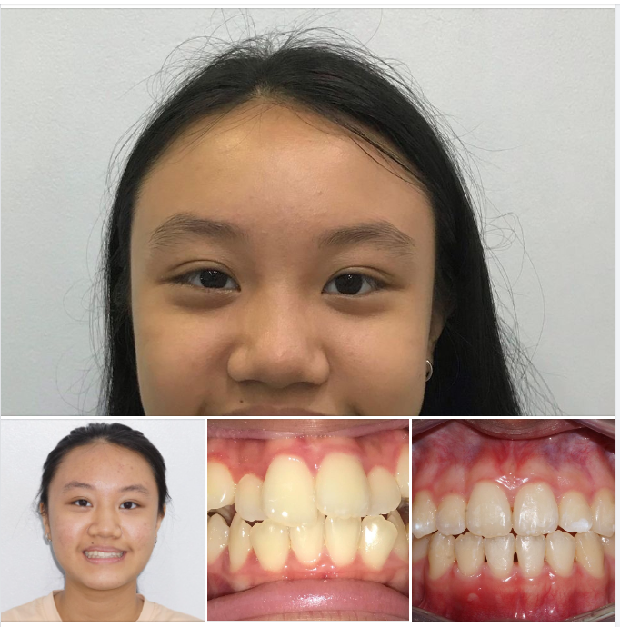 Niềng răng cho trẻ em, cần phải rất đúng thời điểm phát triển