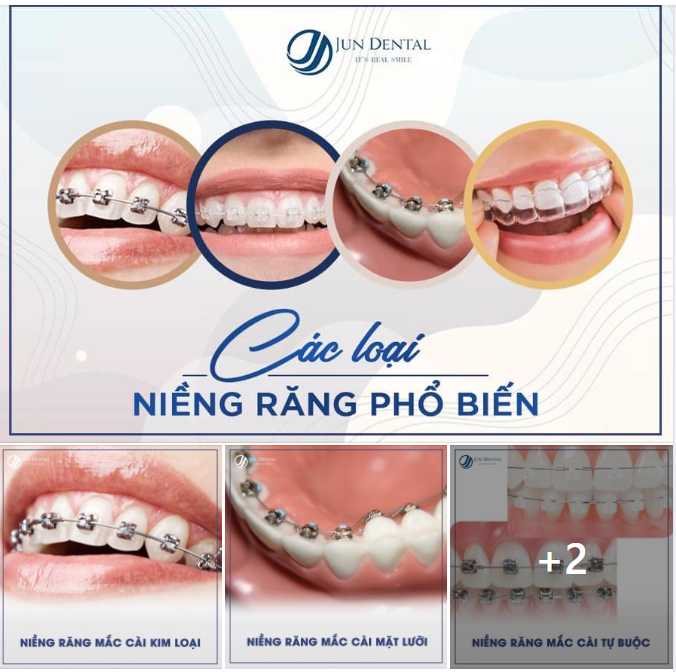 NIỀNG RĂNG CÓ NHỮNG LOẠI NÀO?