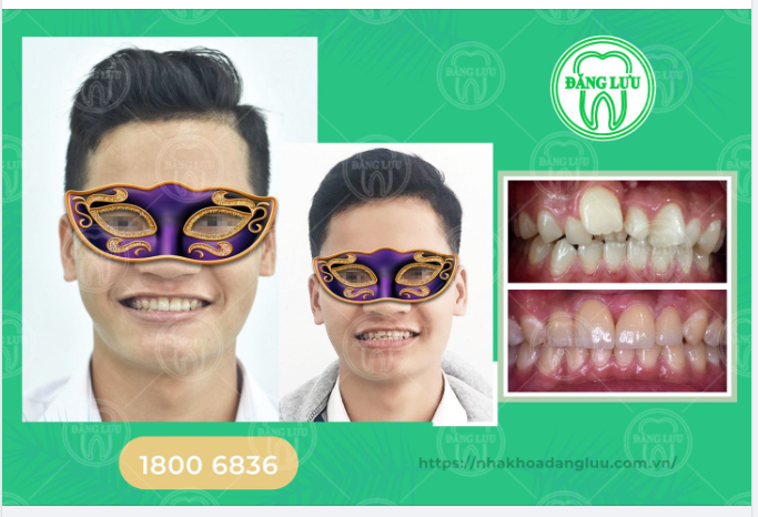 Niềng răng để có khớp cắn chuẩn, sức khỏe răng miệng tốt và nụ cười tự tin