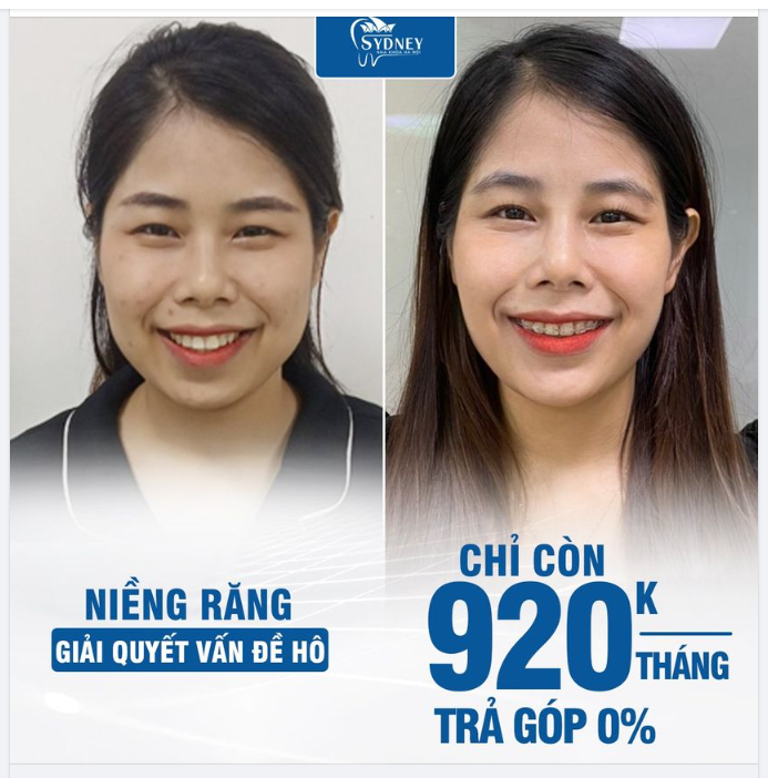 NIỀNG RĂNG - GIẢI QUYẾT VẤN ĐỀ HÔ