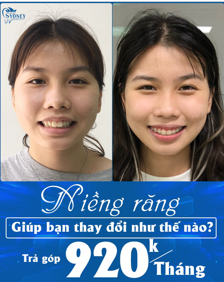 NIỀNG RĂNG GIÚP BẠN THAY ĐỔI NHƯ THẾ NÀO?