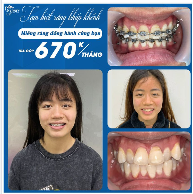 Niềng răng giúp điều chỉnh khớp cắn làm cho khuôn mặt trở nên cân đối, hài hòa hơn.