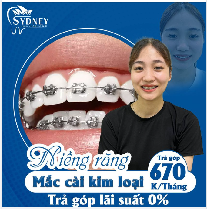NIỀNG RĂNG HOÀN THIỆN NỤ CƯỜI
