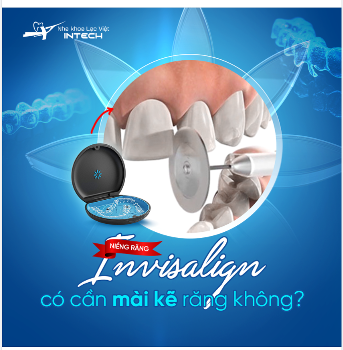 NIỀNG RĂNG INVISALIGN CÓ CẦN MÀI KẼ RĂNG KHÔNG