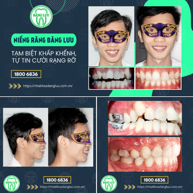 NIỀNG RĂNG KHẤP KHỂNH