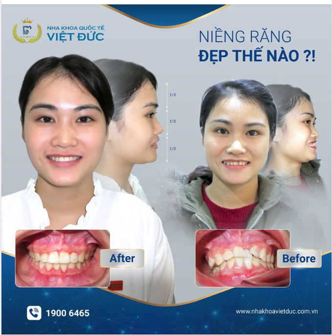 NIỀNG RĂNG, KHÔNG CHỈ RĂNG MÀ GƯƠNG MẶT CŨNG SẼ THAY ĐỔI
