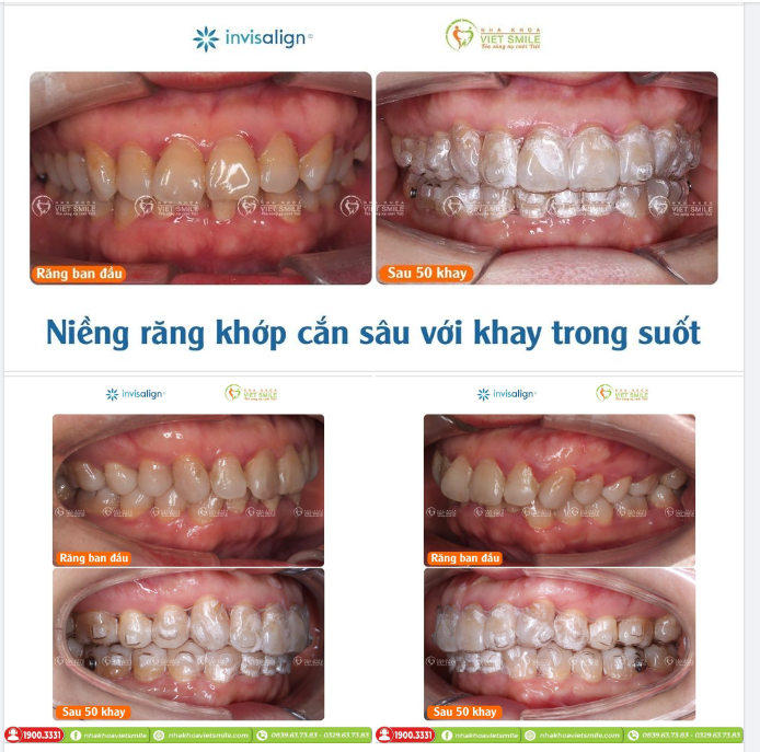 NIỀNG RĂNG KHỚP CẮN SÂU VỚI KHAY TRONG SUỐT