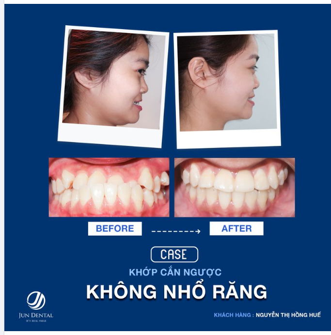 NIỀNG RĂNG LÀ PHẢI NHỔ RĂNG???
