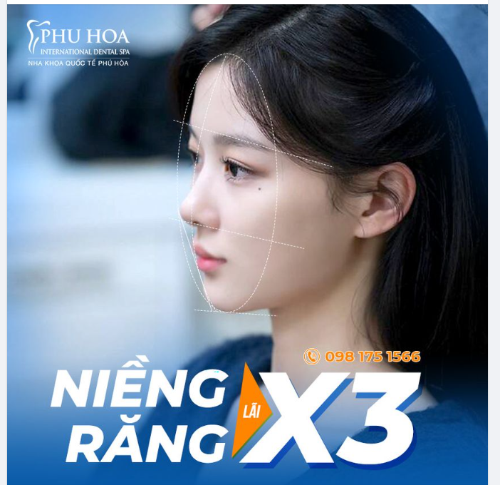 NIỀNG RĂNG LÃI X3