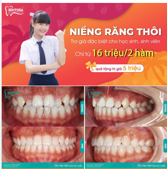 NIỀNG RĂNG MẮC CÀI CHỈ TỪ 16 TRIỆU - RÚT NGẮN 6 THÁNG