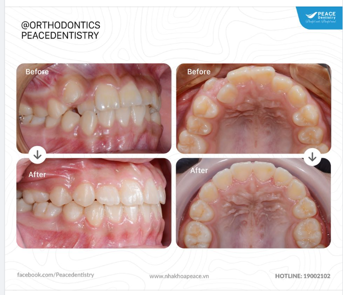   Niềng răng mắc cài kim loại (Hoàn thành sau 20 tháng)
