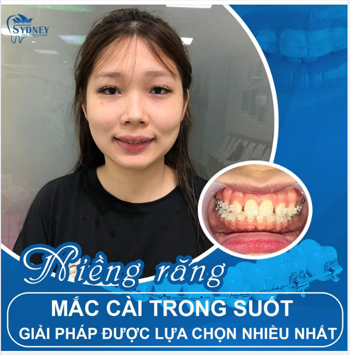 NIỀNG RĂNG MẮC CÀI PHA LÊ – NIỀNG RĂNG THẨM MỸ CHO HIỆU QUẢ VƯỢT TRỘI