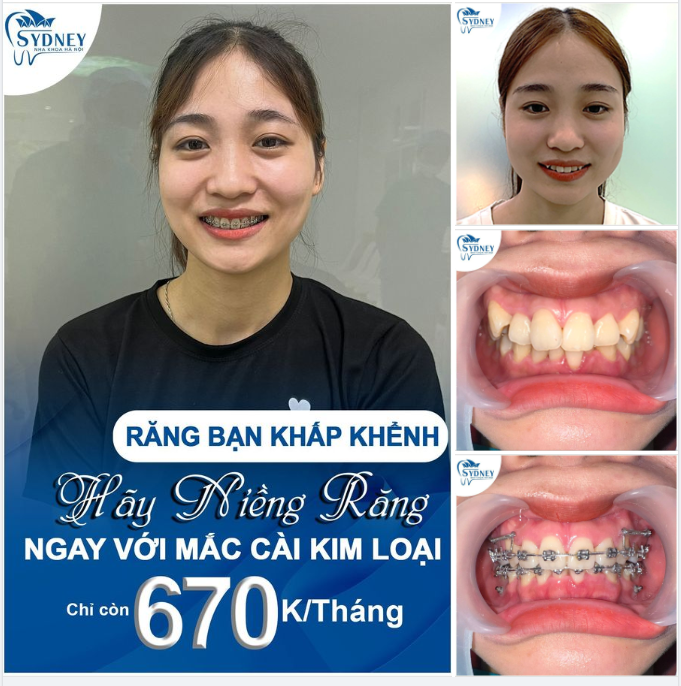 NIỀNG RĂNG NGAY – CHỚ ĐỂ LÂU!