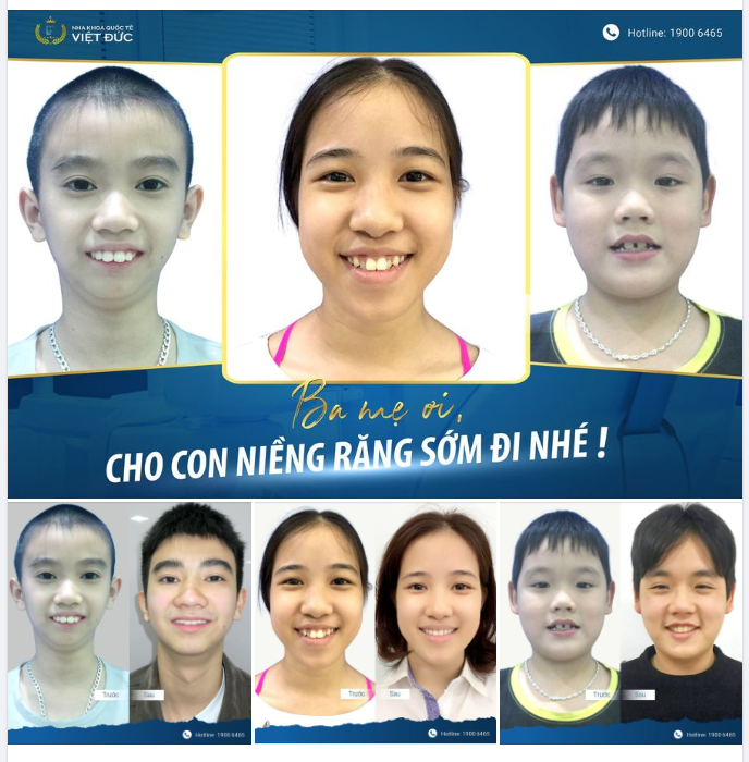 NIỀNG RĂNG SỚM - TẶNG CON TƯƠNG LAI TỐT ĐẸP
