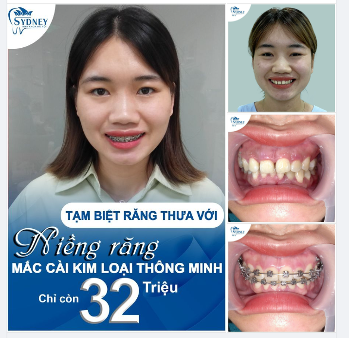 NIỀNG RĂNG THƯA CÀNG SỚM CÀNG TỐT!