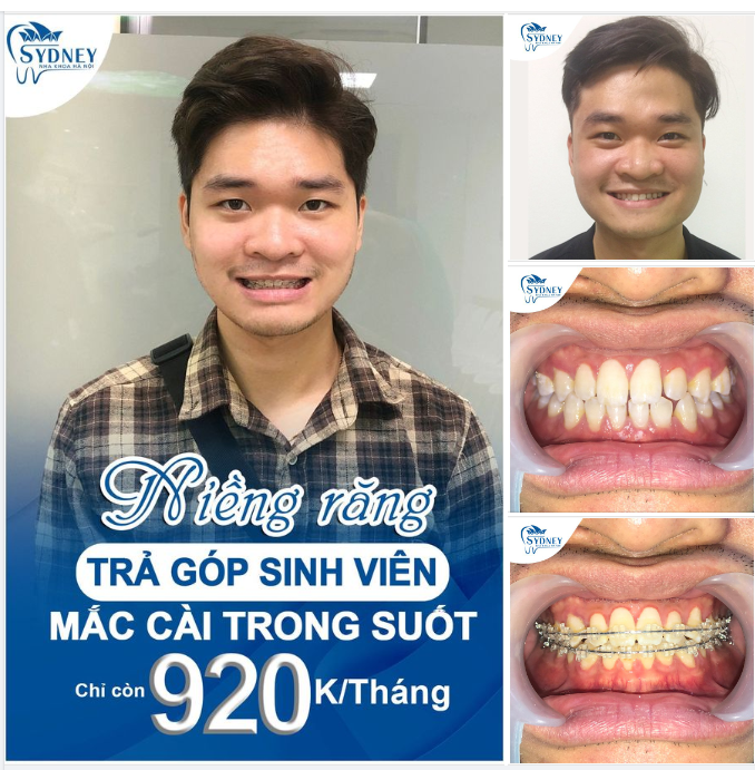 NIỀNG RĂNG THƯA – KHẮC PHỤC HOÀN TOÀN THƯA HỞ