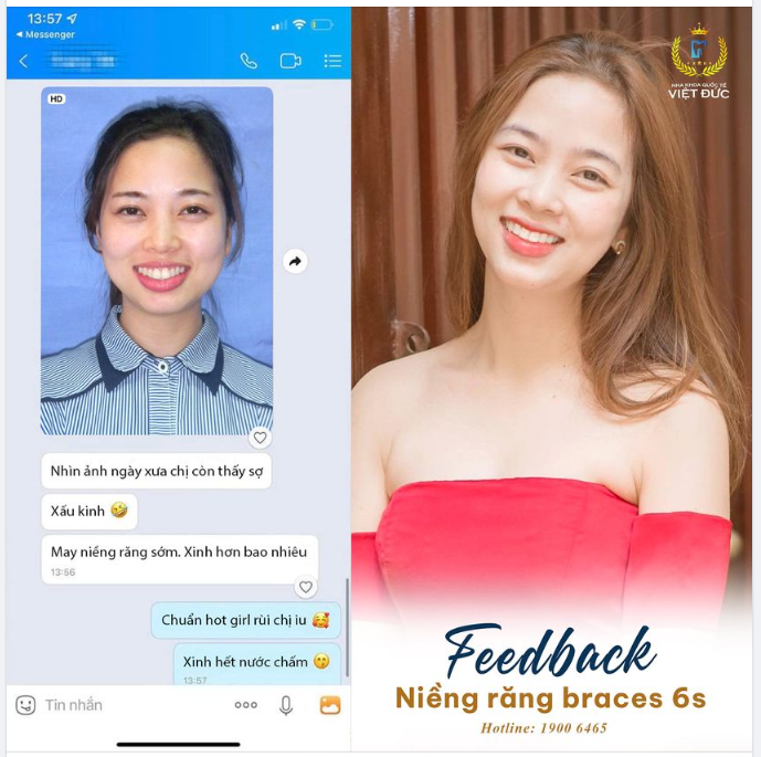NIỀNG RĂNG XONG NHƯ HAI NGƯỜI KHÁC NHAU VẬY